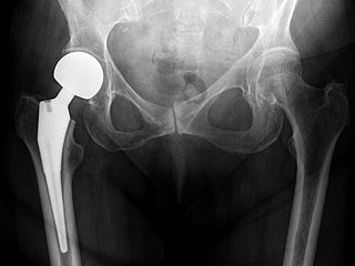 320px-X-ray_of_hips_with_a_hemiarthroplasty